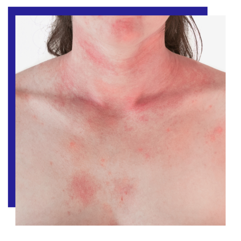 Skin rash / Allergic reaction / Insect bites Services